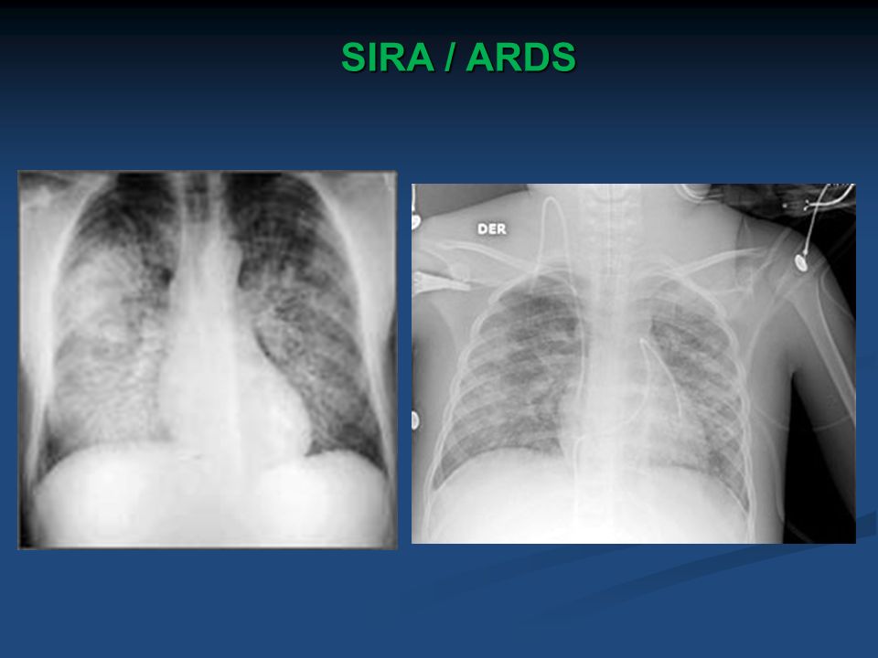 SIRA / ARDS