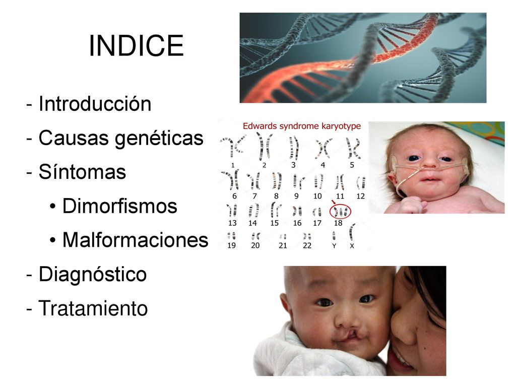 INDICE - Introducción - Causas genéticas - Síntomas • Dimorfismos