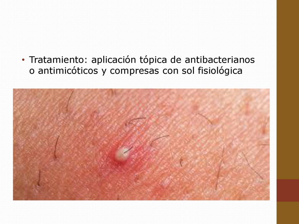 Tratamiento: aplicación tópica de antibacterianos o antimicóticos y compresas con sol fisiológica
