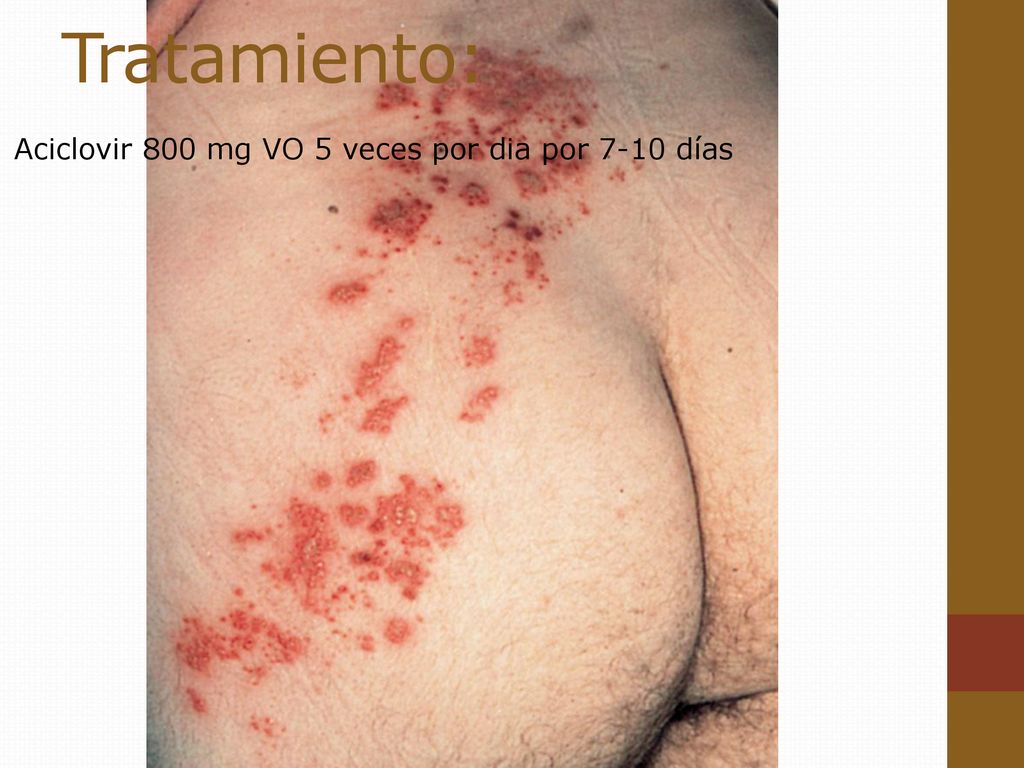 Tratamiento: Aciclovir 800 mg VO 5 veces por dia por 7-10 días