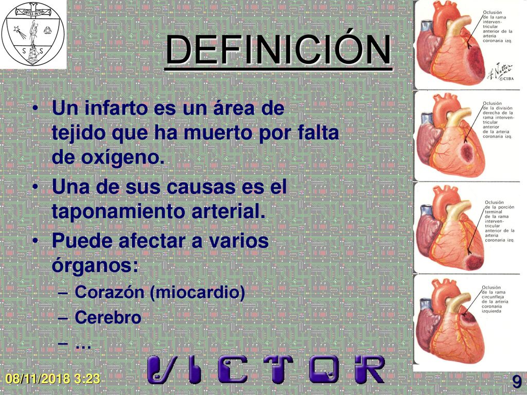 DEFINICIÓN Un infarto es un área de tejido que ha muerto por falta de oxígeno. Una de sus causas es el taponamiento arterial.
