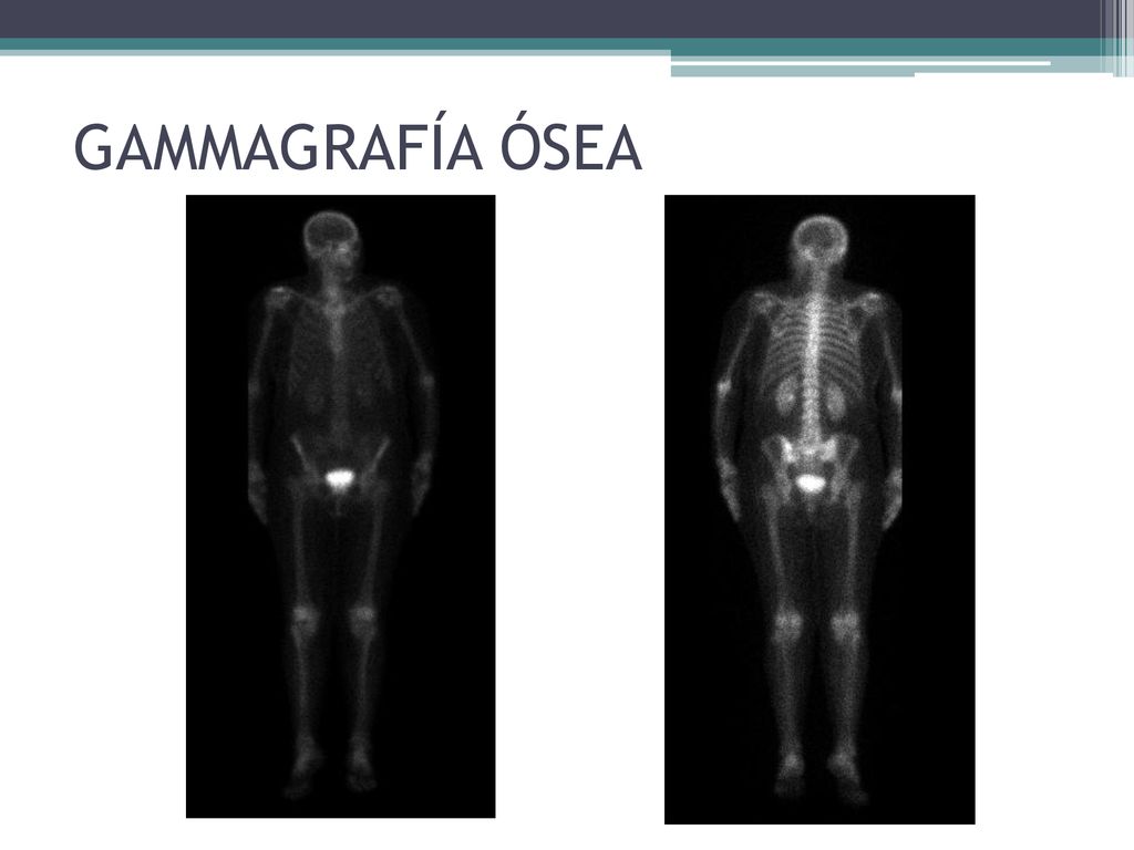 GAMMAGRAFÍA ÓSEA no observándose alteraciones gammagráficas significativas a nivel de la columna dorsal ni en el resto del esqueleto.