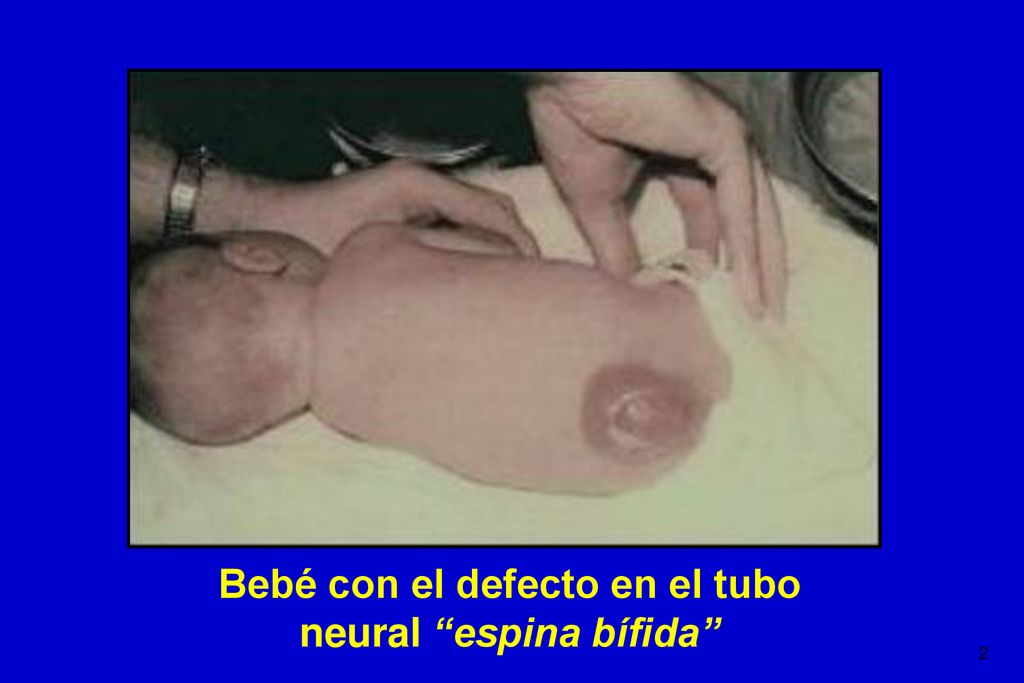 Bebé con el defecto en el tubo neural espina bífida