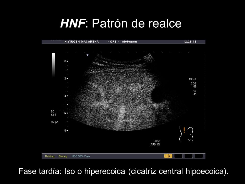 HNF: Patrón de realce Fase tardía: Iso o hiperecoica (cicatriz central hipoecoica).