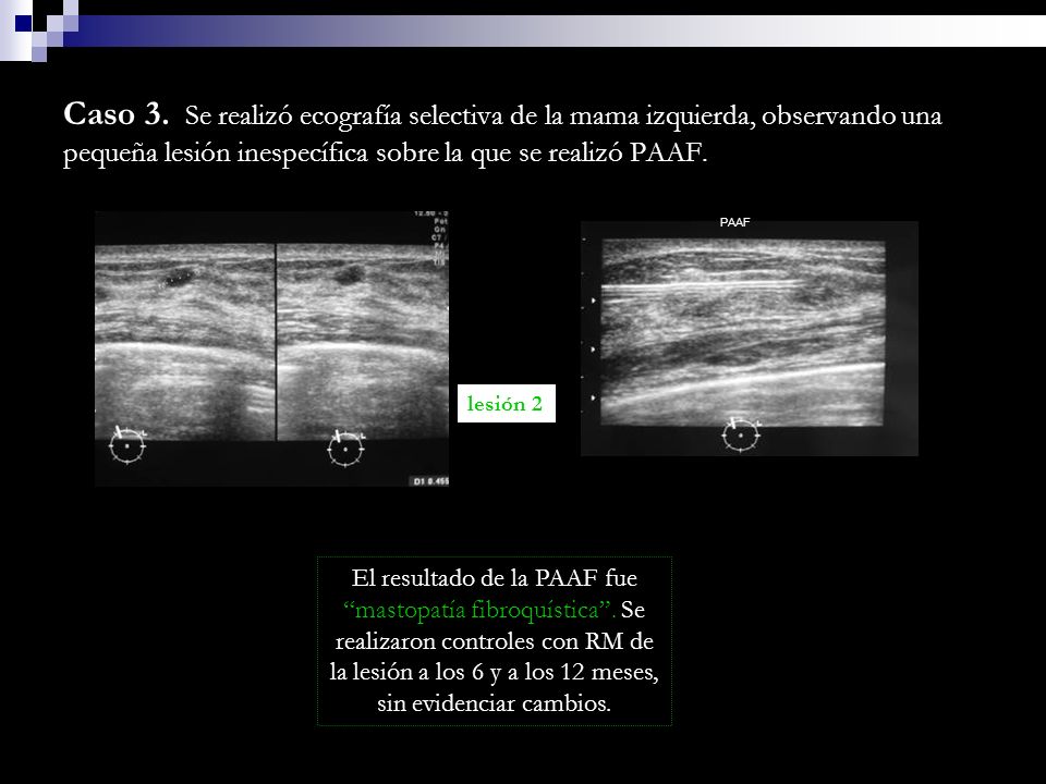 Caso 3. Se realizó ecografía selectiva de la mama izquierda, observando una pequeña lesión inespecífica sobre la que se realizó PAAF.