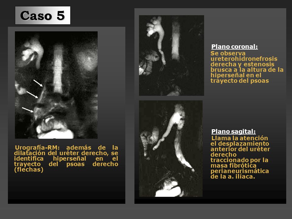 Caso 5 Plano coronal: Se observa ureterohidronefrosis derecha y estenosis brusca a la altura de la hiperseñal en el trayecto del psoas.