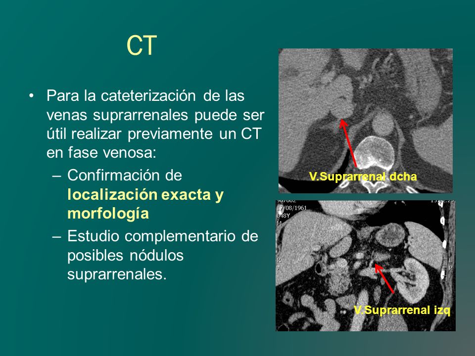 CT Para la cateterización de las venas suprarrenales puede ser útil realizar previamente un CT en fase venosa: