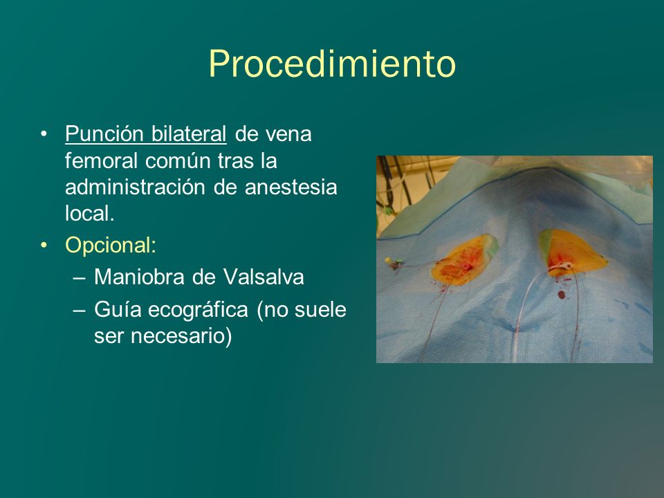 Procedimiento Punción bilateral de vena femoral común tras la administración de anestesia local. Opcional: