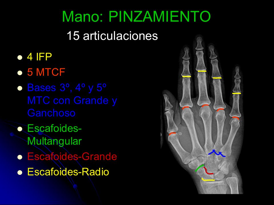 Mano: PINZAMIENTO 15 articulaciones