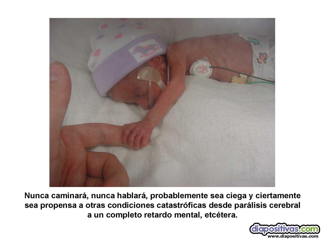 Nunca caminará, nunca hablará, probablemente sea ciega y ciertamente sea propensa a otras condiciones catastróficas desde parálisis cerebral a un completo retardo mental, etcétera.