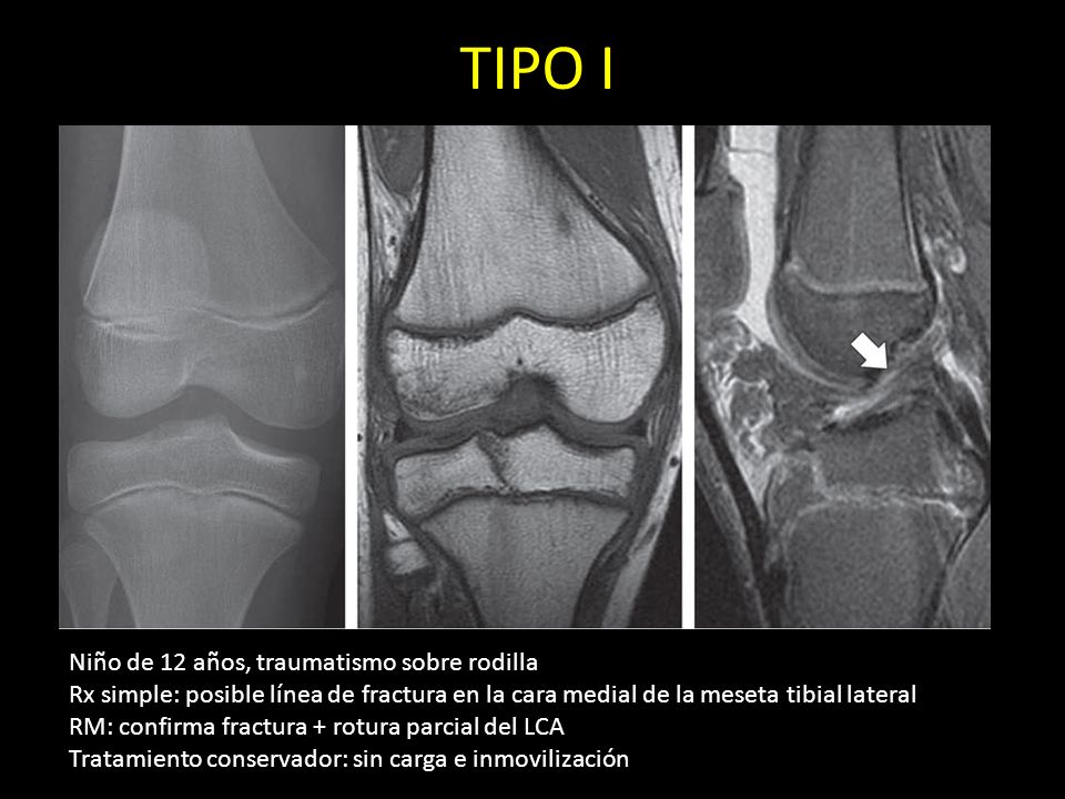 TIPO I Niño de 12 años, traumatismo sobre rodilla