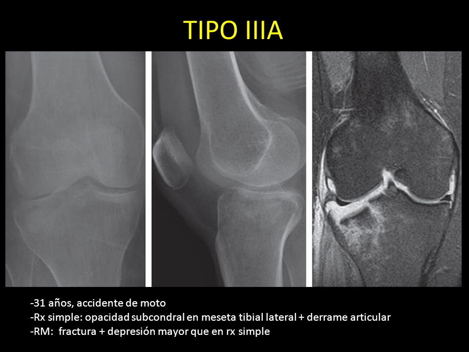 TIPO IIIA -31 años, accidente de moto