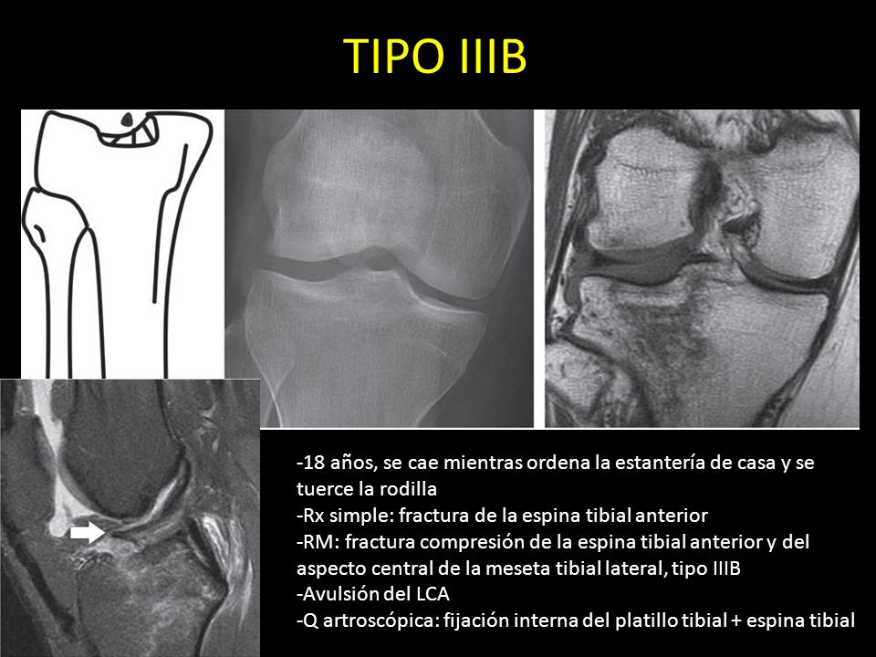 TIPO IIIB -18 años, se cae mientras ordena la estantería de casa y se tuerce la rodilla. -Rx simple: fractura de la espina tibial anterior.