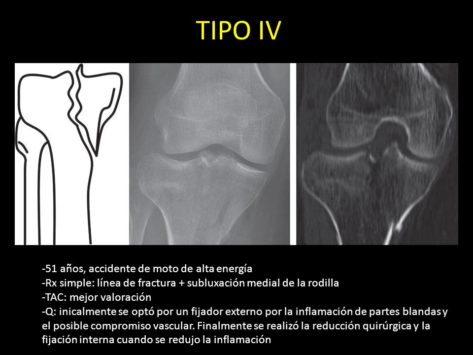 TIPO IV -51 años, accidente de moto de alta energía