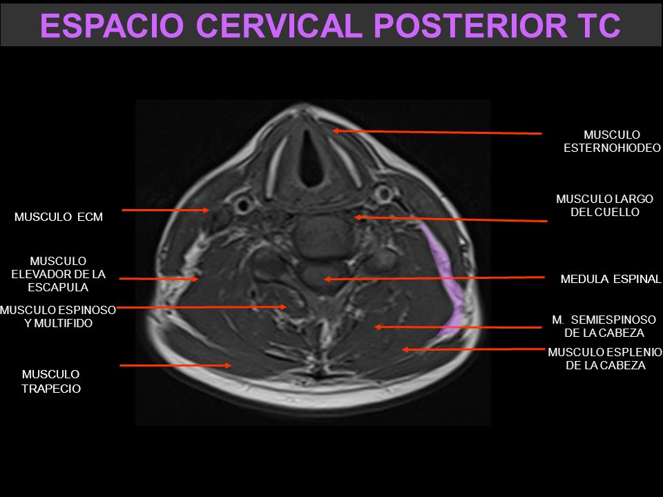 ESPACIO CERVICAL POSTERIOR TC