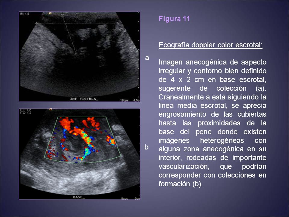 Figura 11 Ecografía doppler color escrotal: