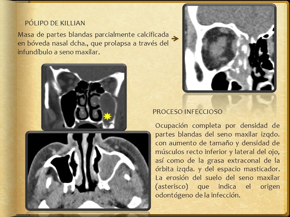 PÓLIPO DE KILLIAN Masa de partes blandas parcialmente calcificada en bóveda nasal dcha., que prolapsa a través del infundíbulo a seno maxilar.