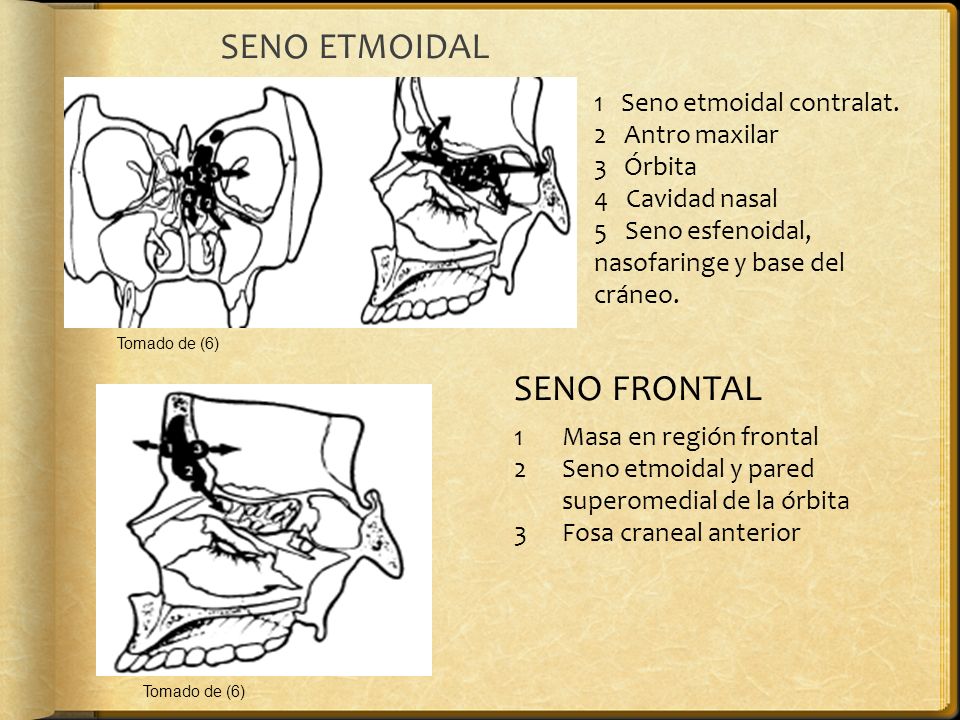SENO ETMOIDAL SENO FRONTAL 1 Seno etmoidal contralat. 2 Antro maxilar