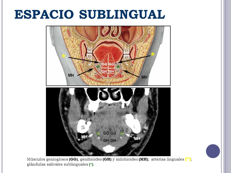 ESPACIO SUBLINGUAL * * * * * * MH MH GG GG MH MH GH GH