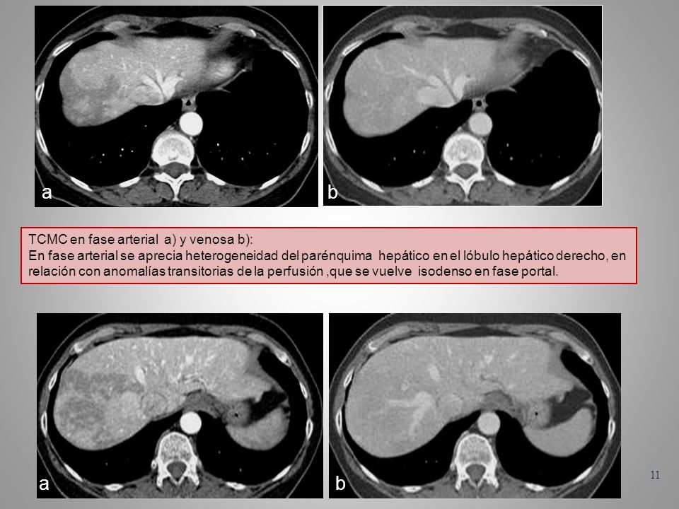 a b a b TCMC en fase arterial a) y venosa b):