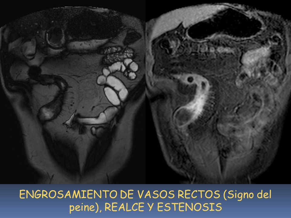 ENGROSAMIENTO DE VASOS RECTOS (Signo del peine), REALCE Y ESTENOSIS