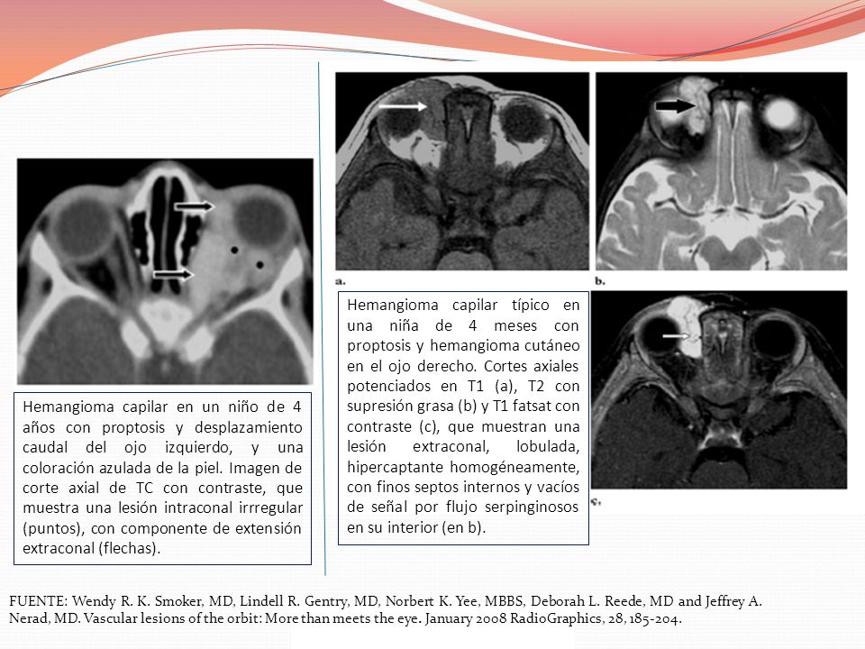 Hemangioma capilar típico en una niña de 4 meses con proptosis y hemangioma cutáneo en el ojo derecho. Cortes axiales potenciados en T1 (a), T2 con supresión grasa (b) y T1 fatsat con contraste (c), que muestran una lesión extraconal, lobulada, hipercaptante homogéneamente, con finos septos internos y vacíos de señal por flujo serpinginosos en su interior (en b).