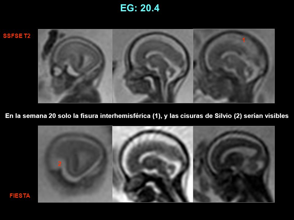 EG: 20.4 SSFSE T2. 1. En la semana 20 solo la fisura interhemisférica (1), y las cisuras de Silvio (2) serían visibles.