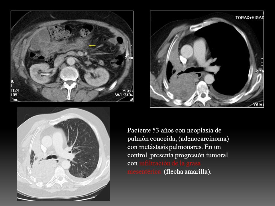 Paciente 53 años con neoplasia de pulmón conocida, (adenocarcinoma) con metástasis pulmonares.