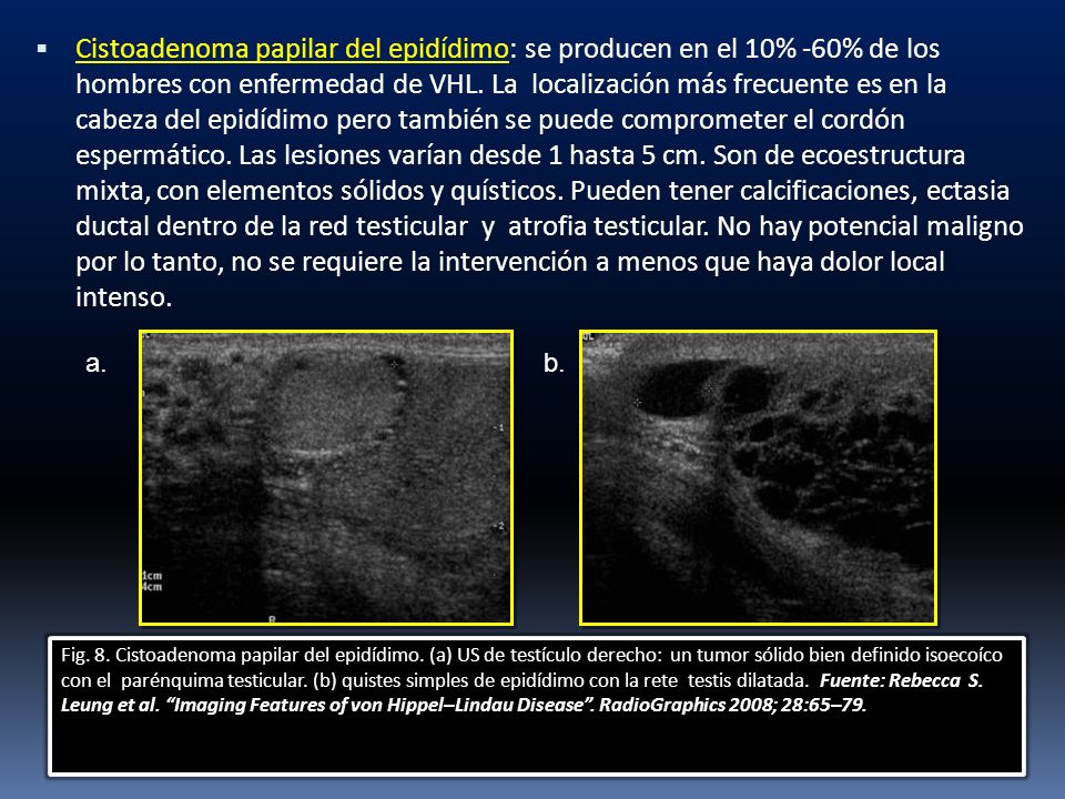Cistoadenoma papilar del epidídimo: se producen en el 10% -60% de los hombres con enfermedad de VHL. La localización más frecuente es en la cabeza del epidídimo pero también se puede comprometer el cordón espermático. Las lesiones varían desde 1 hasta 5 cm. Son de ecoestructura mixta, con elementos sólidos y quísticos. Pueden tener calcificaciones, ectasia ductal dentro de la red testicular y atrofia testicular. No hay potencial maligno por lo tanto, no se requiere la intervención a menos que haya dolor local intenso.