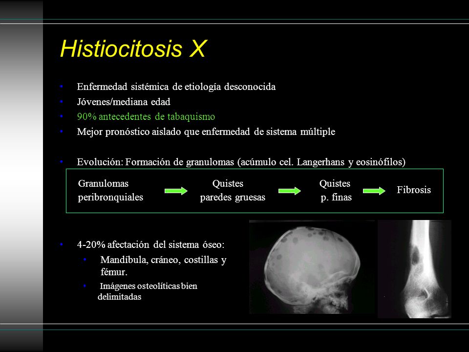 Histiocitosis X Enfermedad sistémica de etiología desconocida