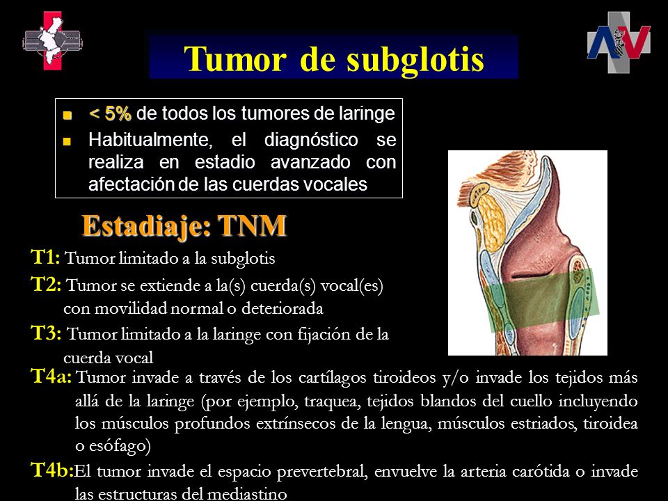 Tumor de subglotis Estadiaje: TNM T1: Tumor limitado a la subglotis