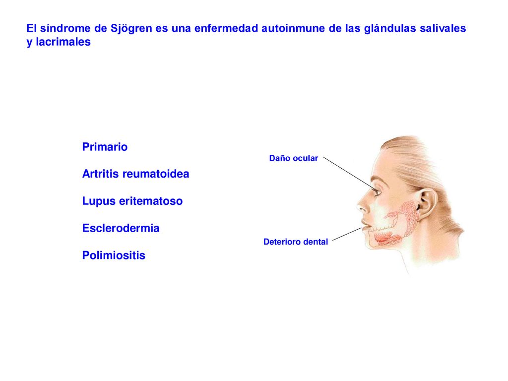 El síndrome de Sjögren es una enfermedad autoinmune de las glándulas salivales y lacrimales