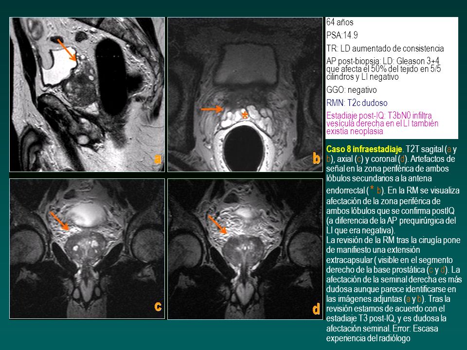 64 años PSA:14.9. TR: LD aumentado de consistencia. AP post-biopsia: LD: Gleason 3+4 que afecta el 50% del tejido en 5/5 cilindros y LI negativo.