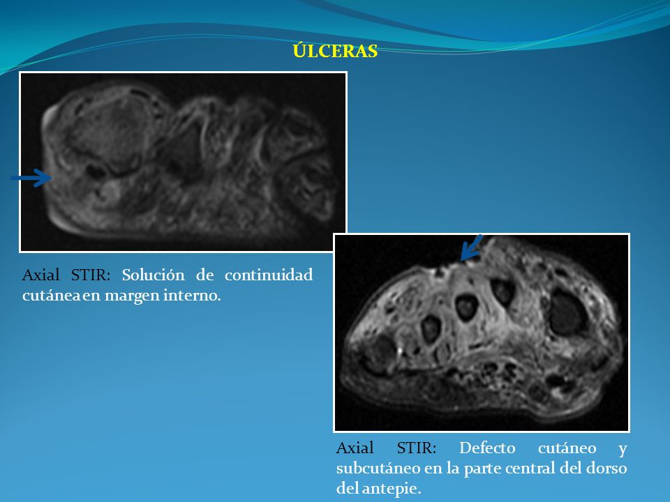 Úlceras Axial STIR: Solución de continuidad cutánea en margen interno.