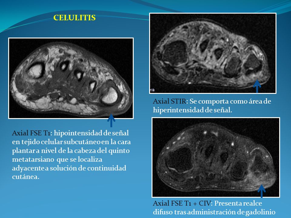 Celulitis Axial STIR: Se comporta como área de hiperintensidad de señal.