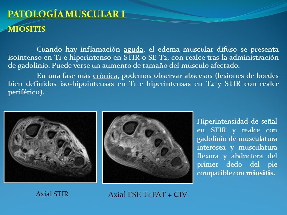PATOLOGÍA MUSCULAR I Miositis Axial FSE T1 FAT + CIV