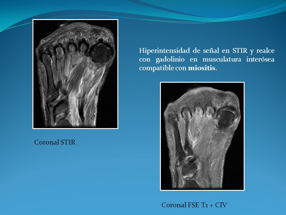 Coronal STIR Coronal FSE T1 + CIV.