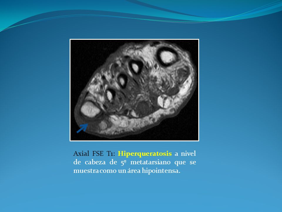 Axial FSE T1: Hiperqueratosis a nivel de cabeza de 5º metatarsiano que se muestra como un área hipointensa.