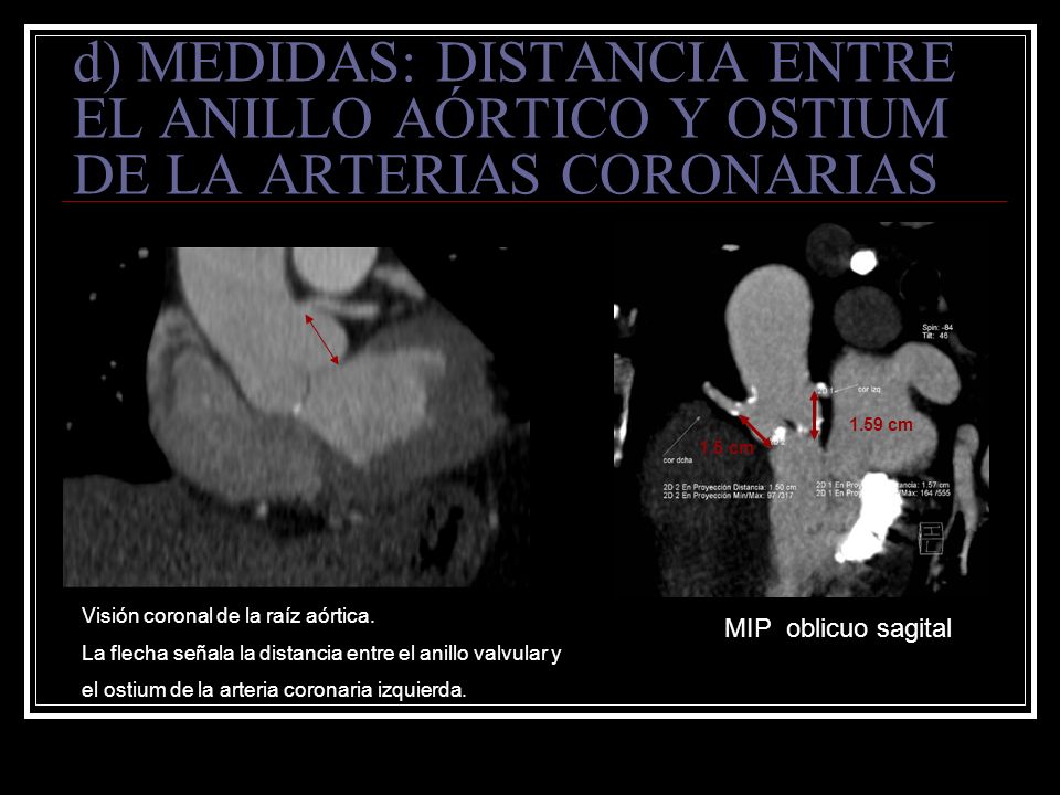 d) MEDIDAS: DISTANCIA ENTRE EL ANILLO AÓRTICO Y OSTIUM DE LA ARTERIAS CORONARIAS