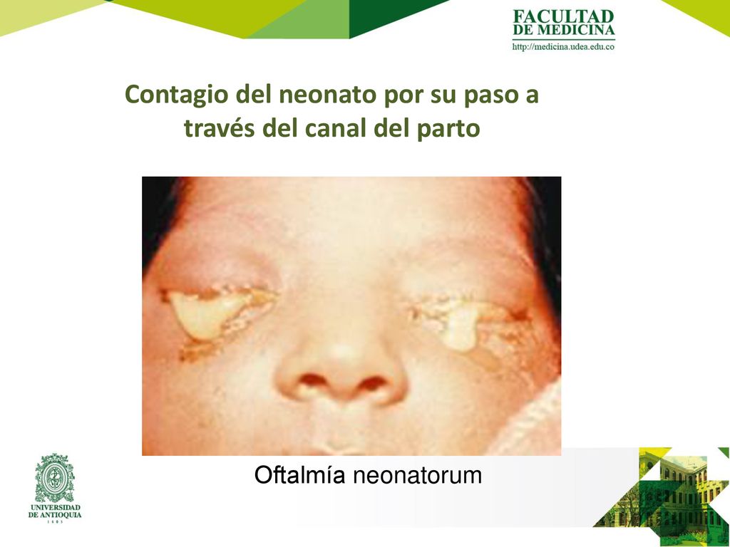 Contagio del neonato por su paso a través del canal del parto