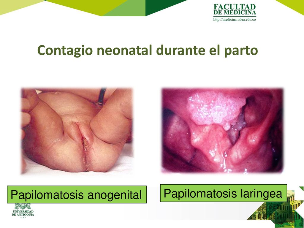 Contagio neonatal durante el parto