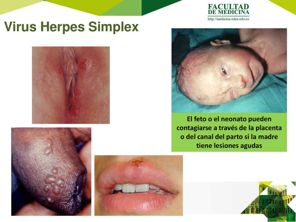 Virus Herpes Simplex El feto o el neonato pueden contagiarse a través de la placenta o del canal del parto si la madre tiene lesiones agudas.