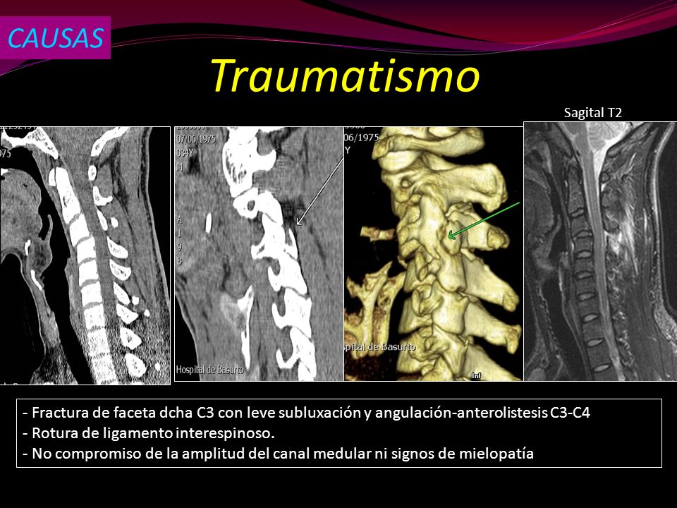 CAUSAS Traumatismo. Sagital T2. - Fractura de faceta dcha C3 con leve subluxación y angulación-anterolistesis C3-C4.