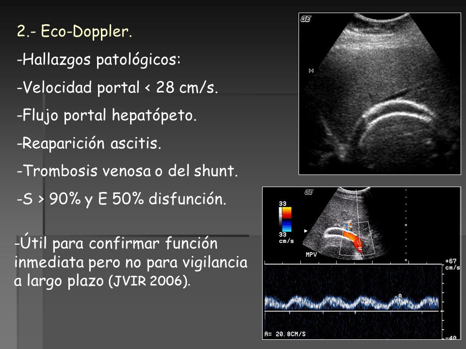 2.- Eco-Doppler. -Hallazgos patológicos: -Velocidad portal < 28 cm/s. -Flujo portal hepatópeto. -Reaparición ascitis.