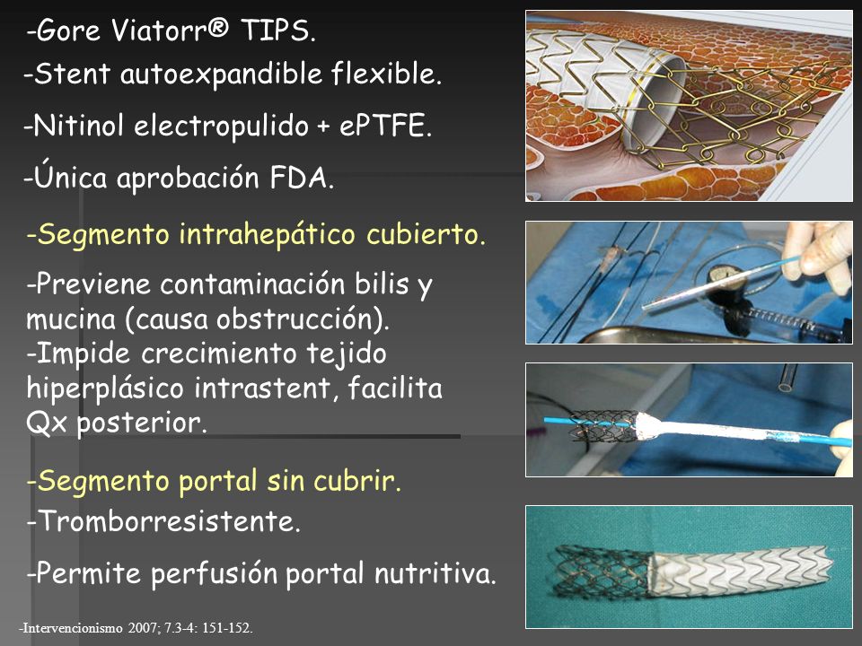 -Stent autoexpandible flexible. -Nitinol electropulido + ePTFE.