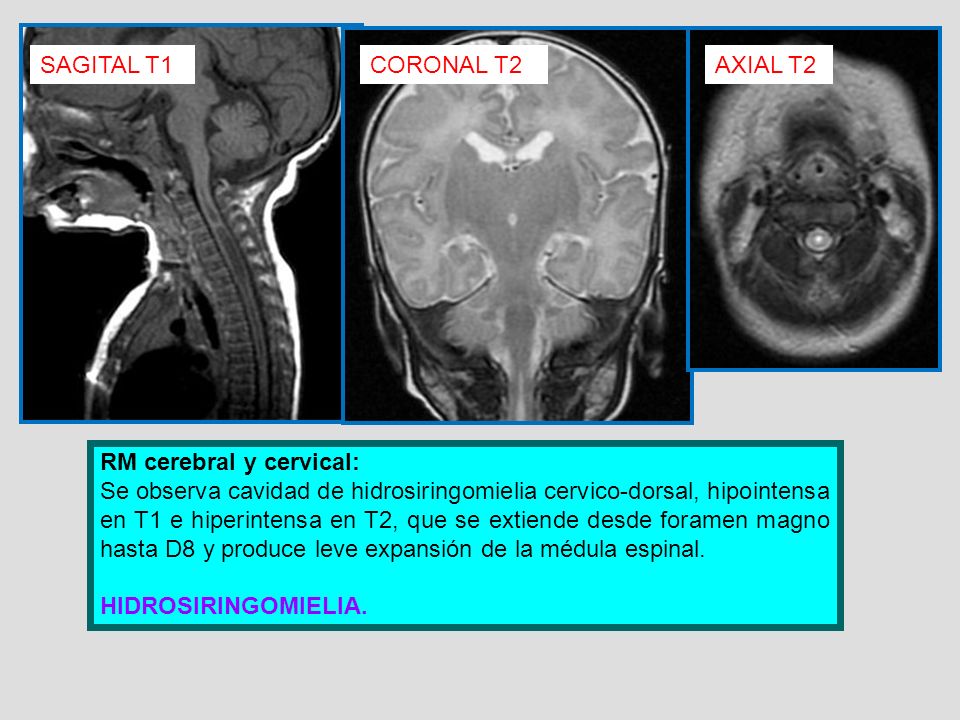 SAGITAL T1 CORONAL T2. AXIAL T2. RM cerebral y cervical: