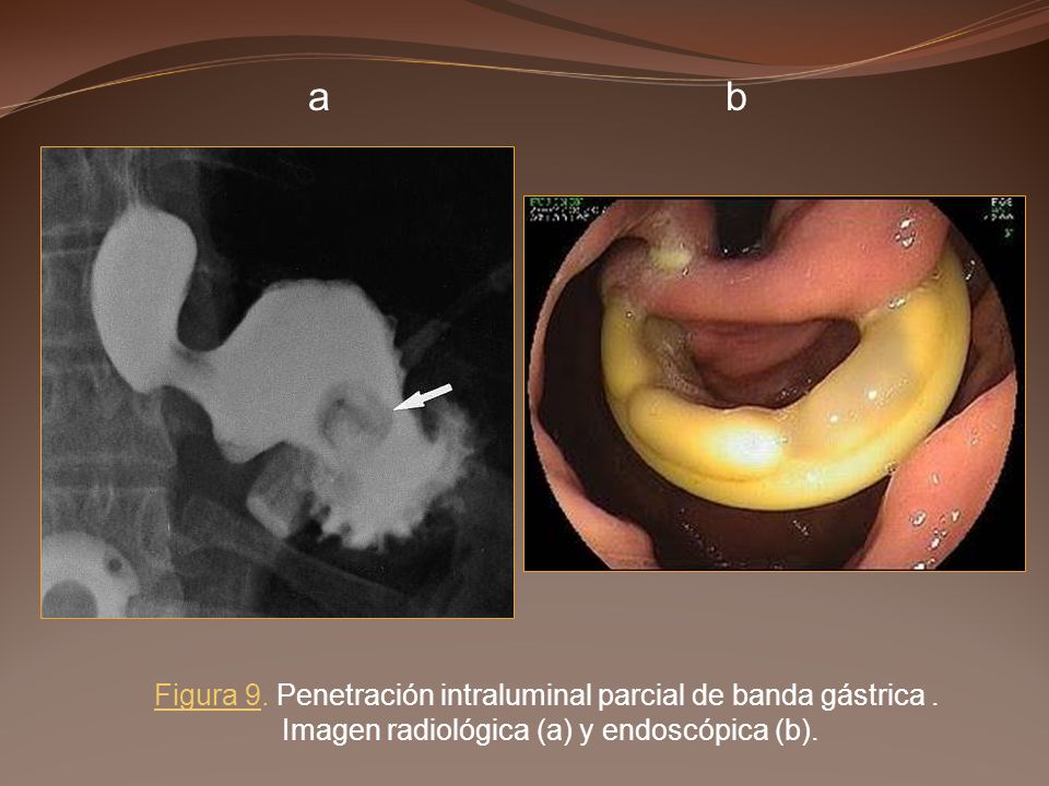 a b Figura 9. Penetración intraluminal parcial de banda gástrica .