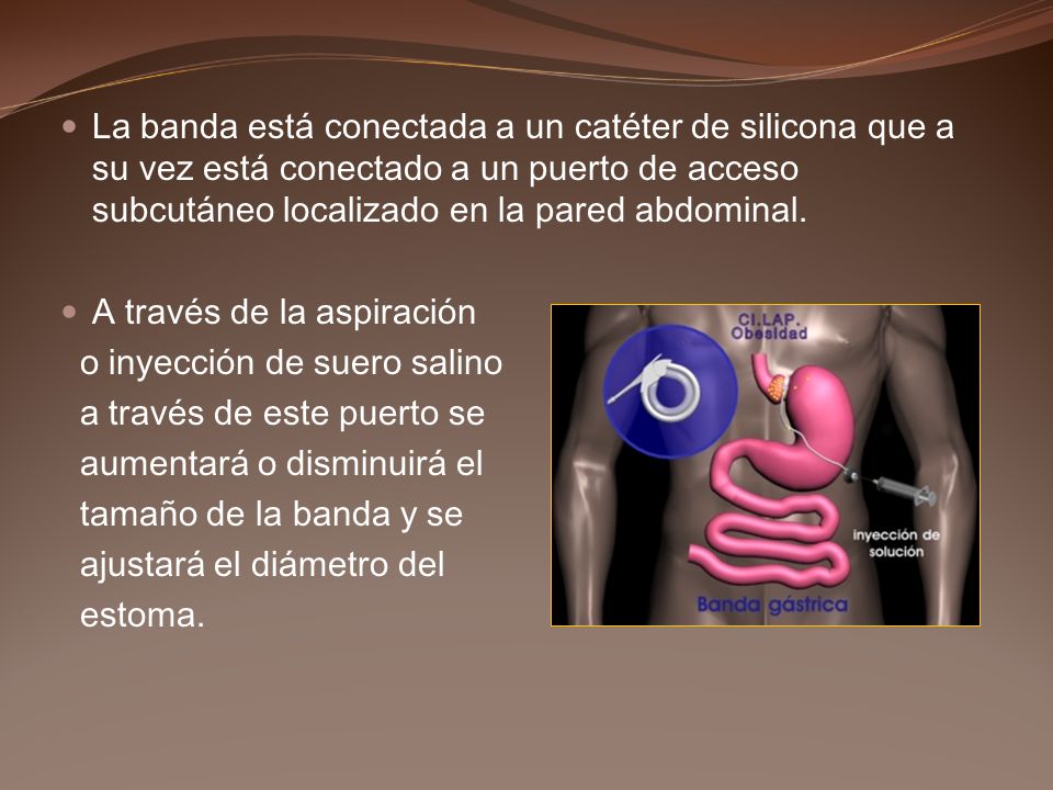 La banda está conectada a un catéter de silicona que a su vez está conectado a un puerto de acceso subcutáneo localizado en la pared abdominal.