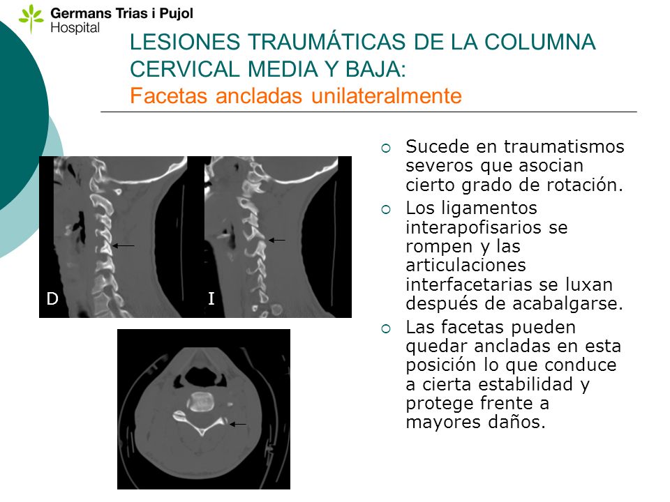 LESIONES TRAUMÁTICAS DE LA COLUMNA CERVICAL MEDIA Y BAJA: Facetas ancladas unilateralmente
