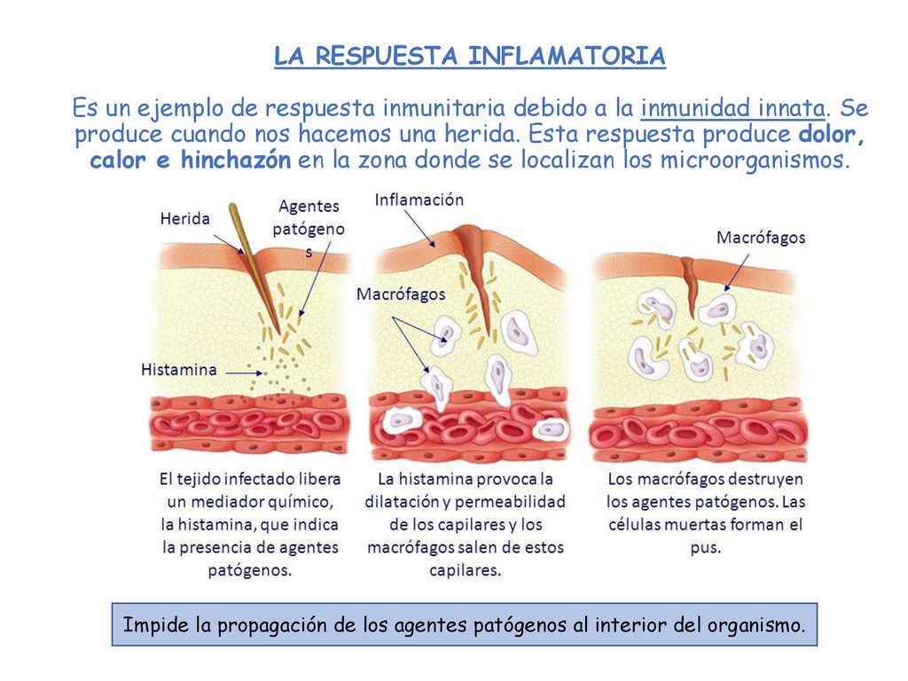 LA RESPUESTA INFLAMATORIA Es un ejemplo de respuesta inmunitaria debido a la inmunidad innata. Se produce cuando nos hacemos una herida. Esta respuesta produce dolor, calor e hinchazón en la zona donde se localizan los microorganismos.